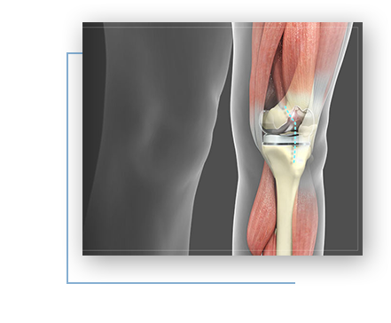 Rosa Robotic Surgical System