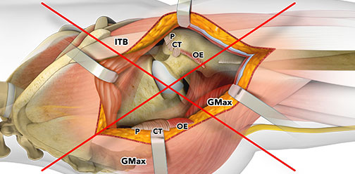 Traditional  open posterior THA is no longer required and has not been performed by Dr. Penenberg in more than 14 years