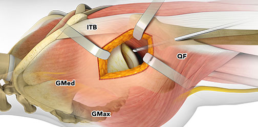 Patented Portal Assisted Total Hip allows preservation of tendon attachments